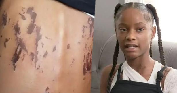  11 வயது சிறுமி மீது ஆசிட் வீச்சு -  அமெரிக்காவில் அதிர்ச்சி சம்பவம்